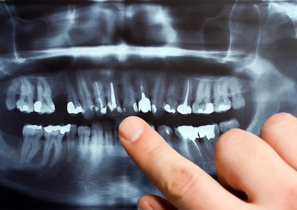 初期の虫歯から徹底した診断を行います